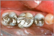 invisable fillings before image