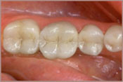 invisable fillings before after image